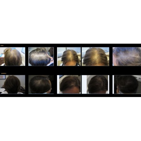 Kompleksowy system do analizy, laserowej terapii oraz oksydacji skóry głowy i włosów